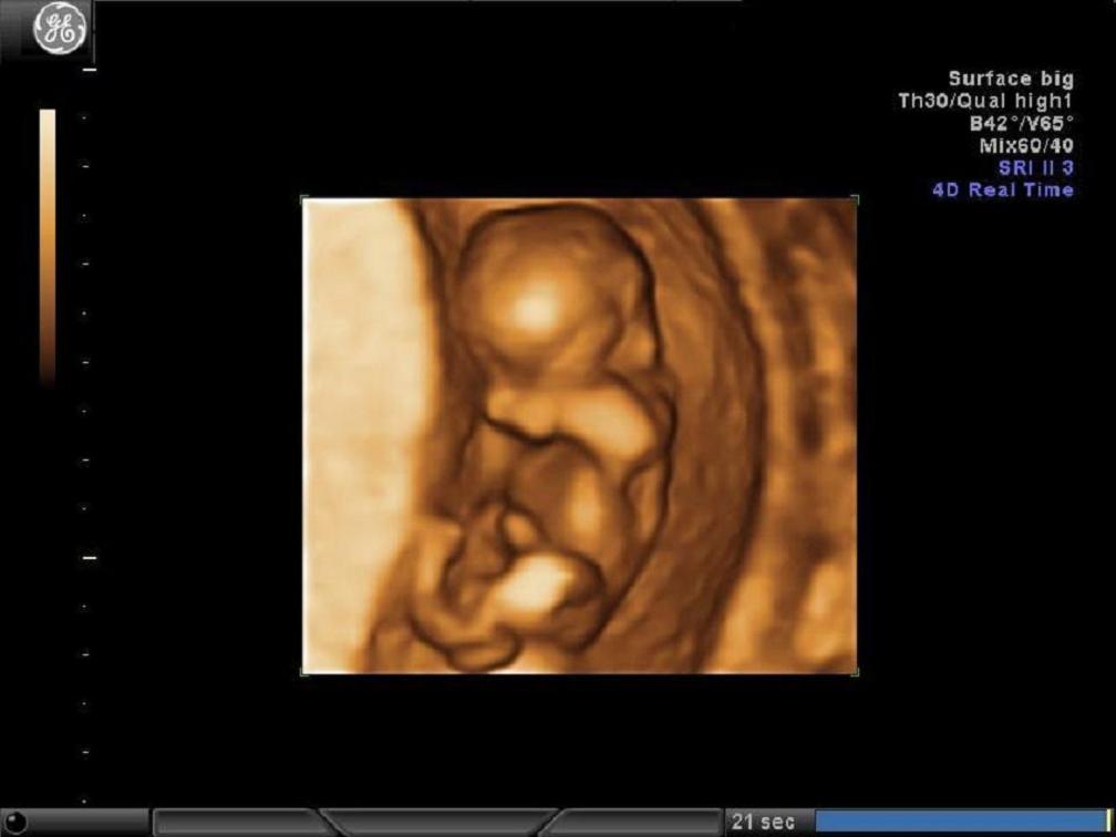Obraz płodu w badaniu 4D w I trymestrze ciąży