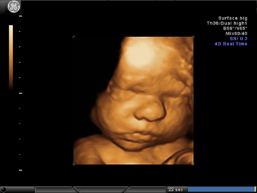 Twarz płodu w badaniu 4D w III trymestrze ciąży
